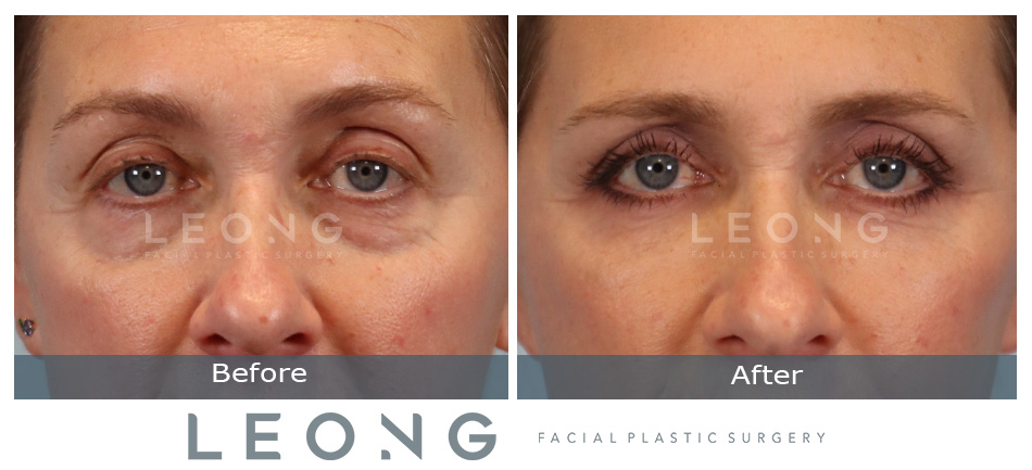 Blepharoplasty Before and After | Leong Facial Plastic Surgery