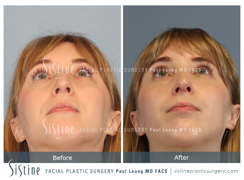Chin Implant Before and After | Leong Facial Plastic Surgery