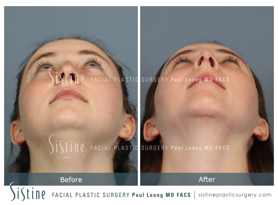 Chin Implant Before and After | Leong Facial Plastic Surgery