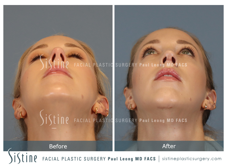 Chin Implant Before and After | Leong Facial Plastic Surgery