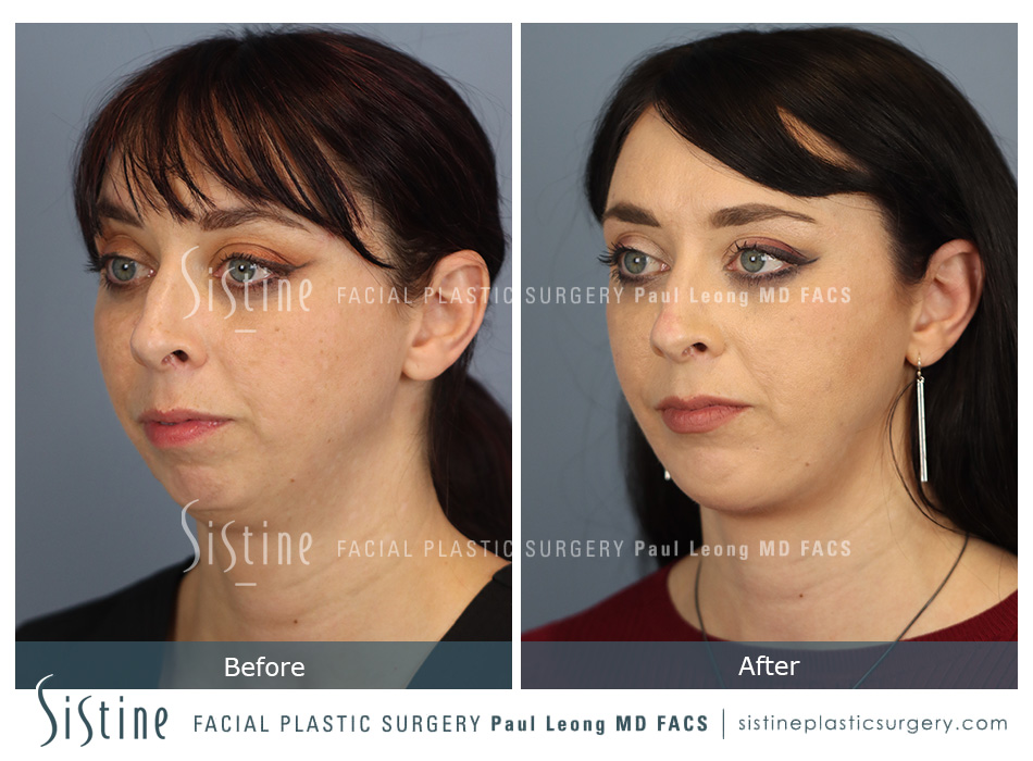 Chin Implant Before and After | Leong Facial Plastic Surgery