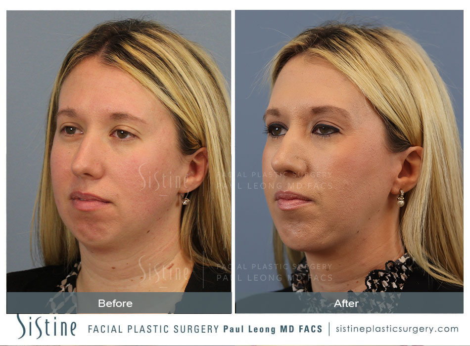 Chin Implant Before and After | Leong Facial Plastic Surgery