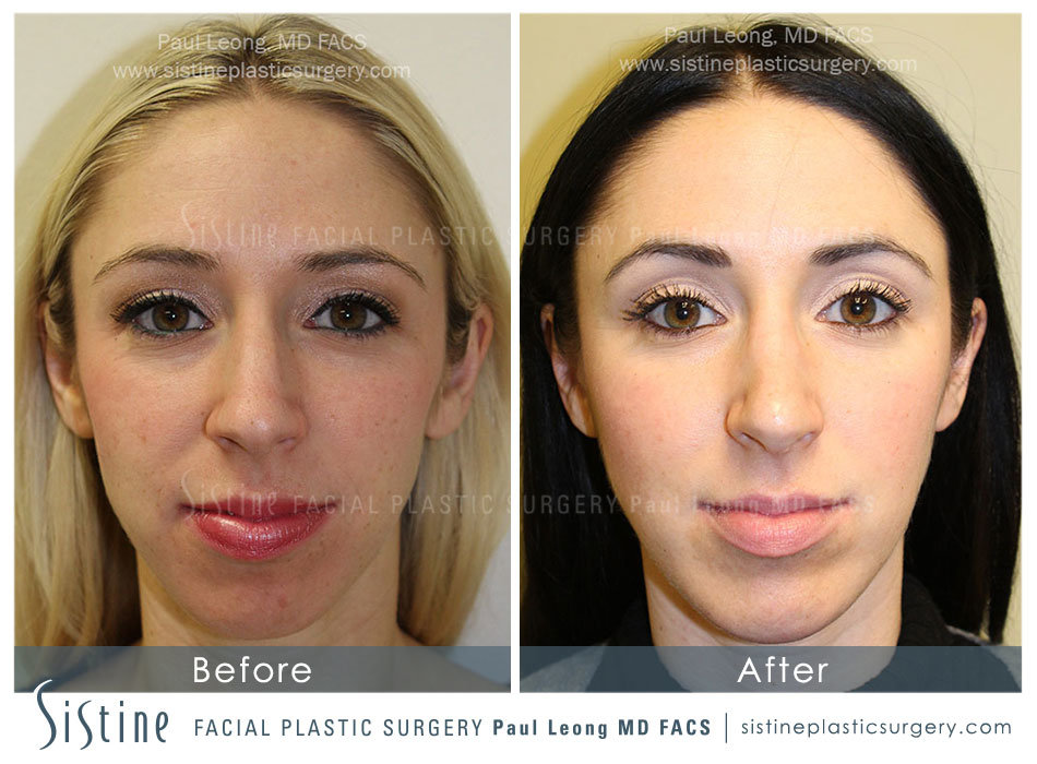 Chin Implant Before and After | Leong Facial Plastic Surgery