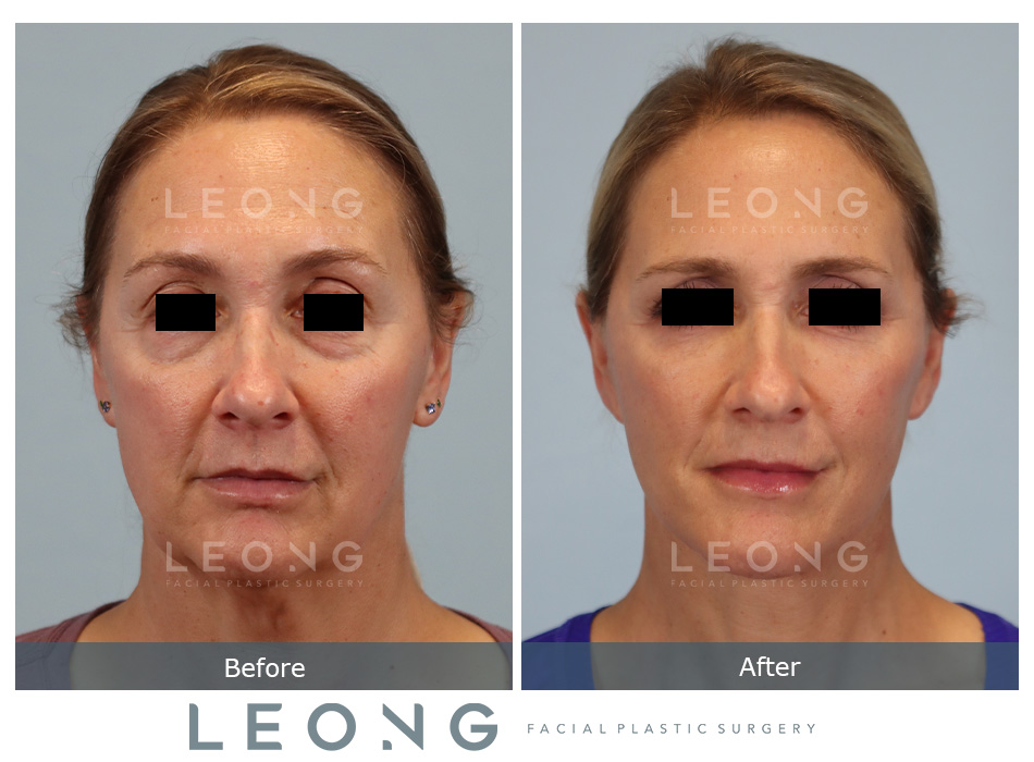 Facelift Before and After | Leong Facial Plastic Surgery