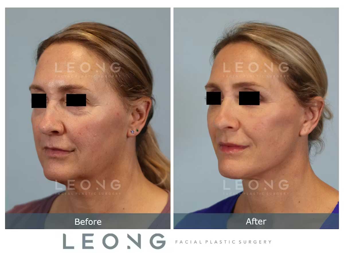 Facelift Before and After | Leong Facial Plastic Surgery