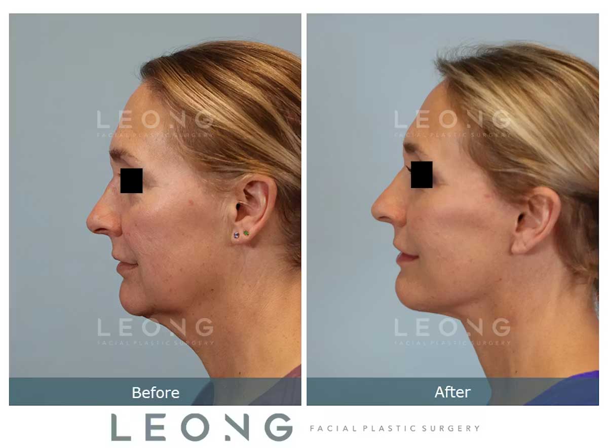 Facelift Before and After | Leong Facial Plastic Surgery
