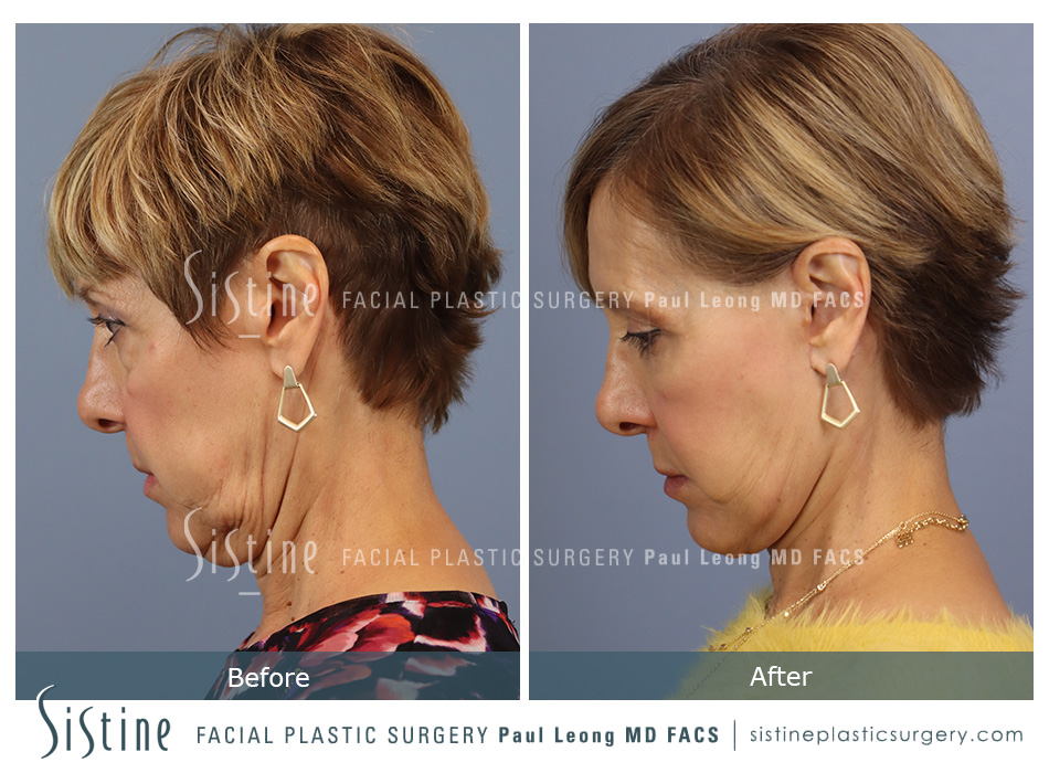 Facelift Before and After | Leong Facial Plastic Surgery