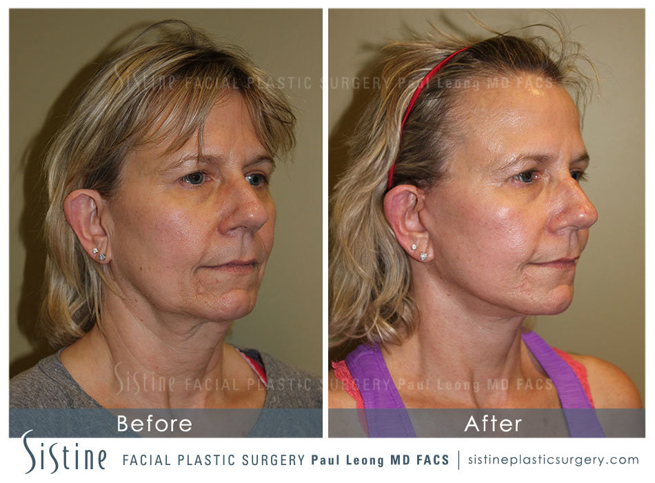 Facelift Before and After | Leong Facial Plastic Surgery