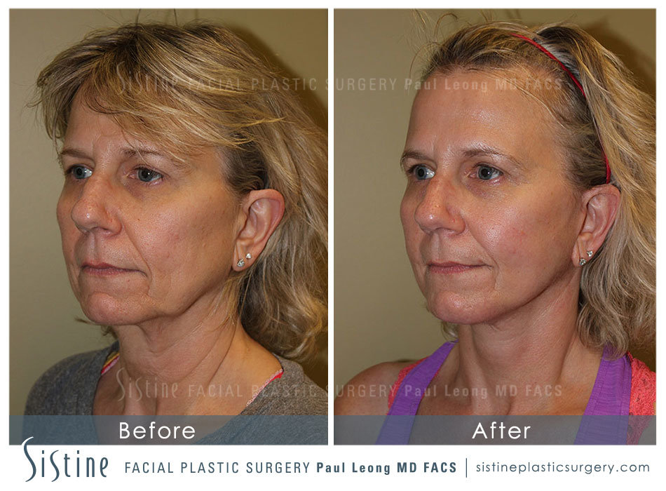 Facelift Before and After | Leong Facial Plastic Surgery