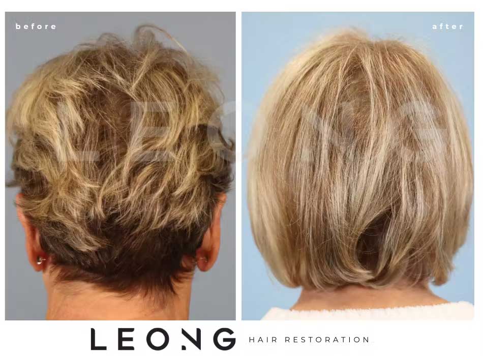 Hair Transplant Before and After | Leong Facial Plastic Surgery