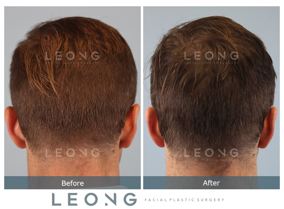 Hair Transplant Before and After | Leong Facial Plastic Surgery