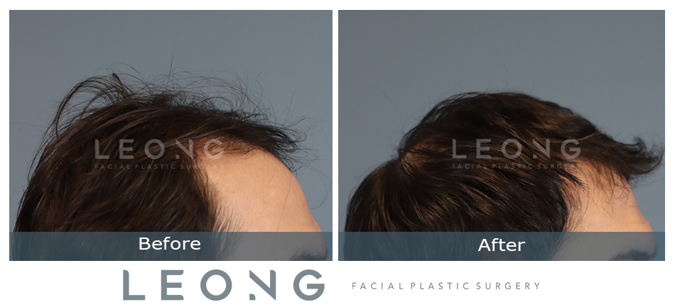 Hair Transplant Before and After | Leong Facial Plastic Surgery