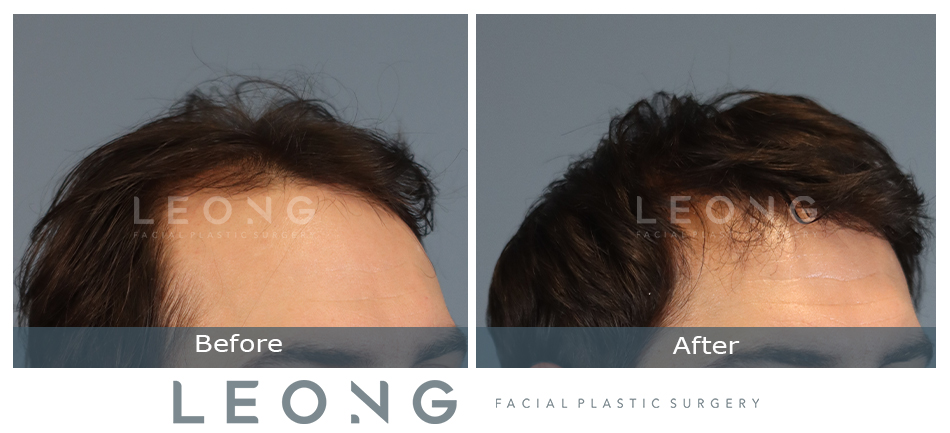 Hair Transplant Before and After | Leong Facial Plastic Surgery