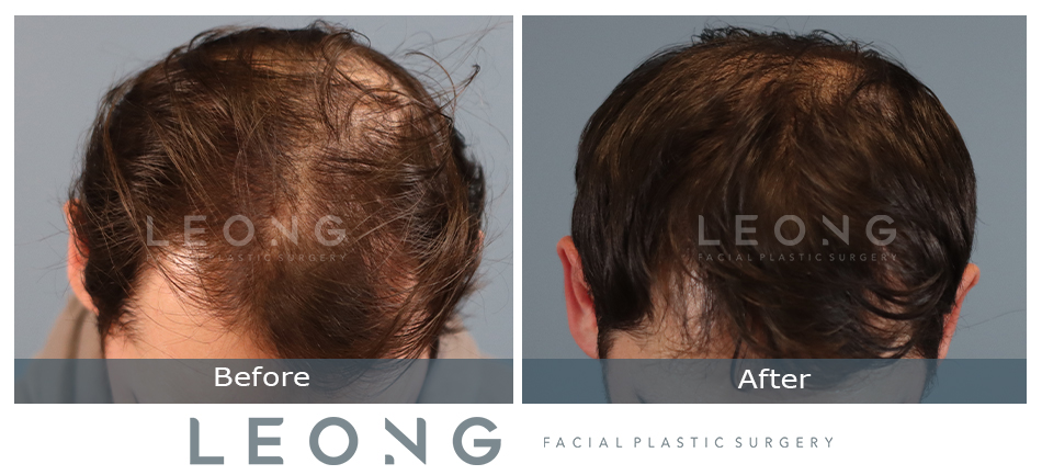 Hair Transplant Before and After | Leong Facial Plastic Surgery