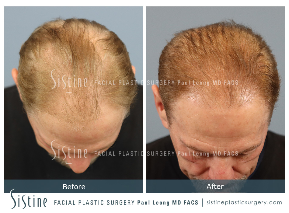 Hair Transplant Before and After | Leong Facial Plastic Surgery