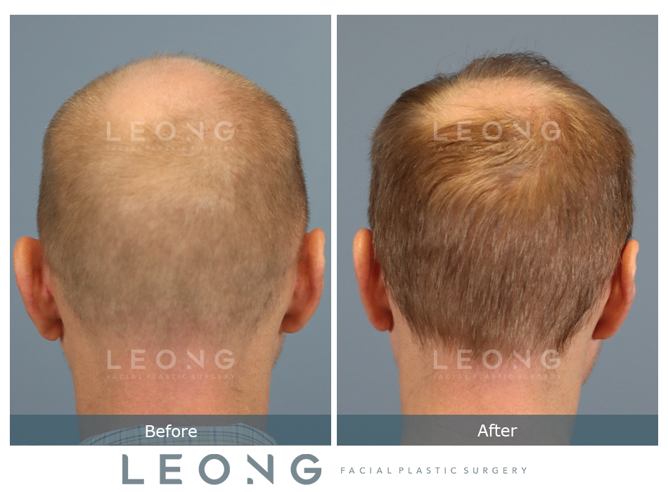 Hair Transplant Before and After | Leong Facial Plastic Surgery