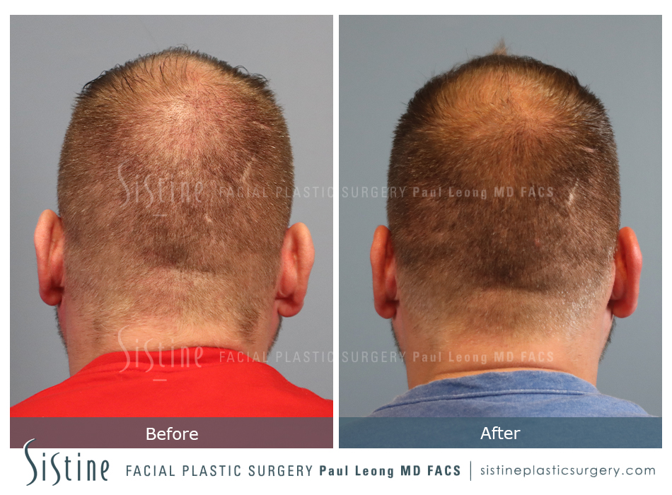 Hair Transplant Before and After | Leong Facial Plastic Surgery