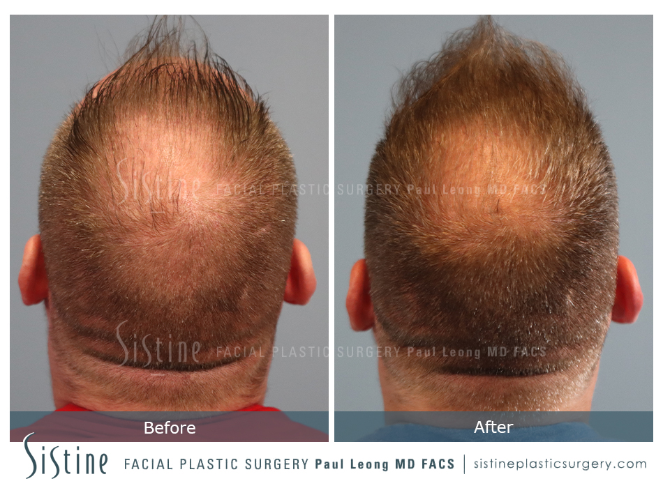 Hair Transplant Before and After | Leong Facial Plastic Surgery