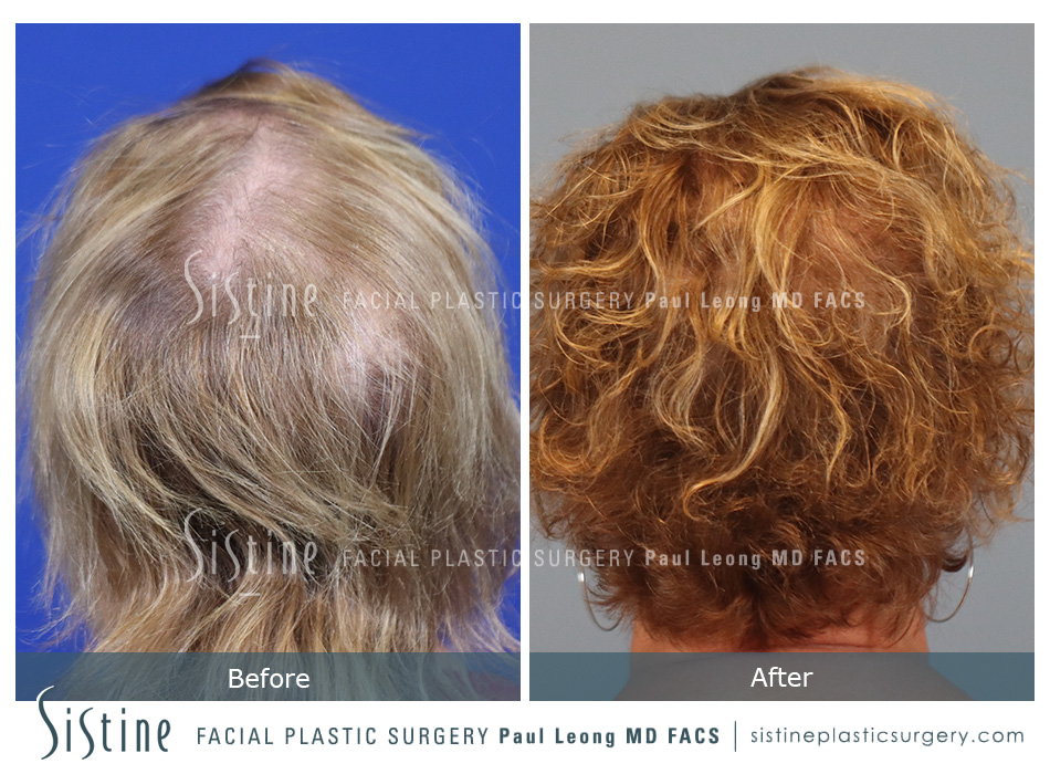 Hair Transplant Before and After | Leong Facial Plastic Surgery