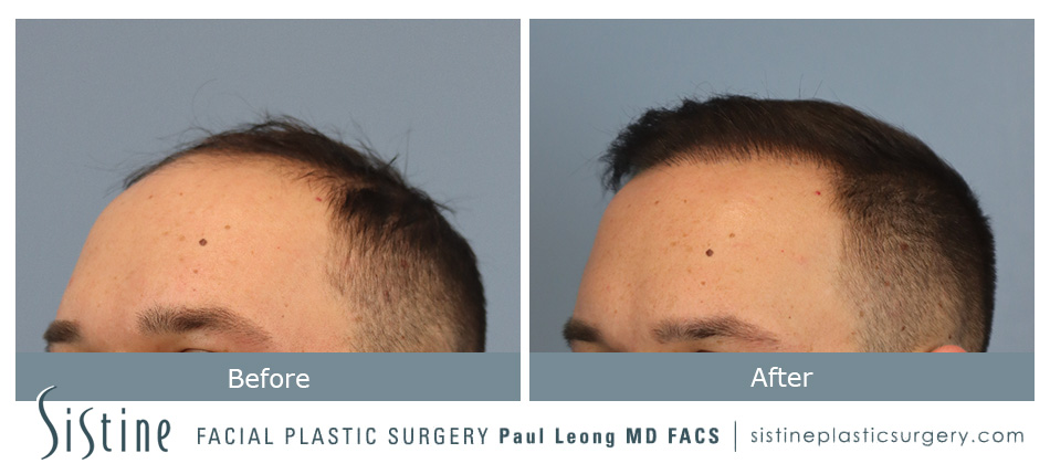Hair Transplant Before and After | Leong Facial Plastic Surgery