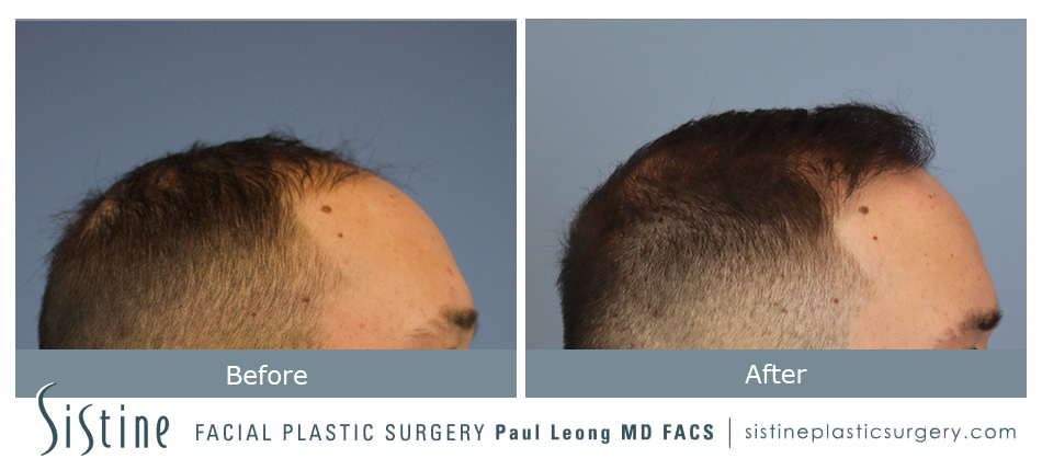 Hair Transplant Before and After | Leong Facial Plastic Surgery