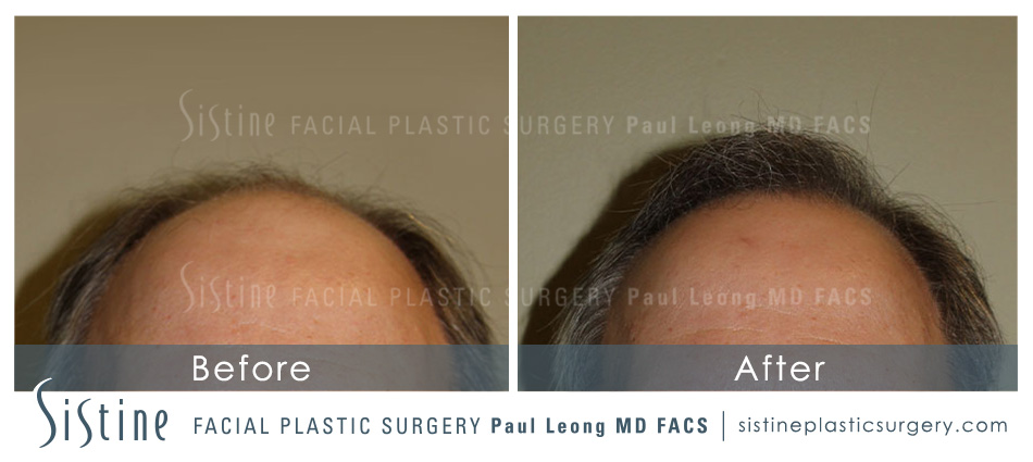 Hair Transplant Before and After | Leong Facial Plastic Surgery