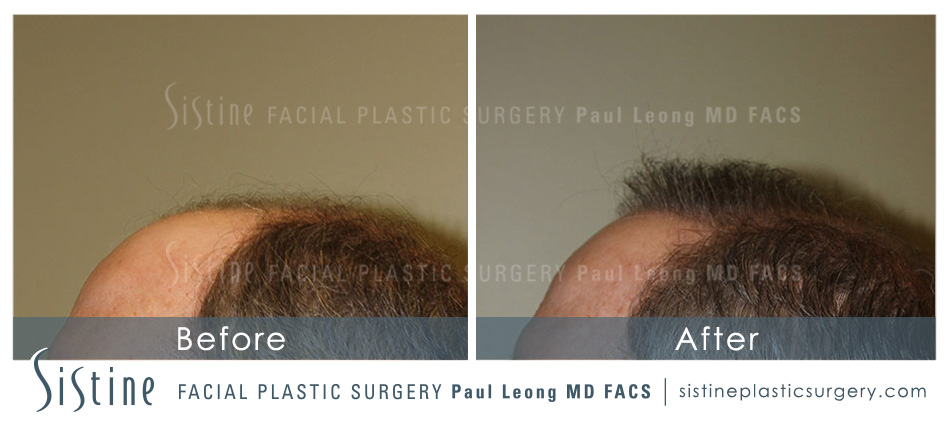 Hair Transplant Before and After | Leong Facial Plastic Surgery