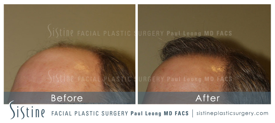 Hair Transplant Before and After | Leong Facial Plastic Surgery