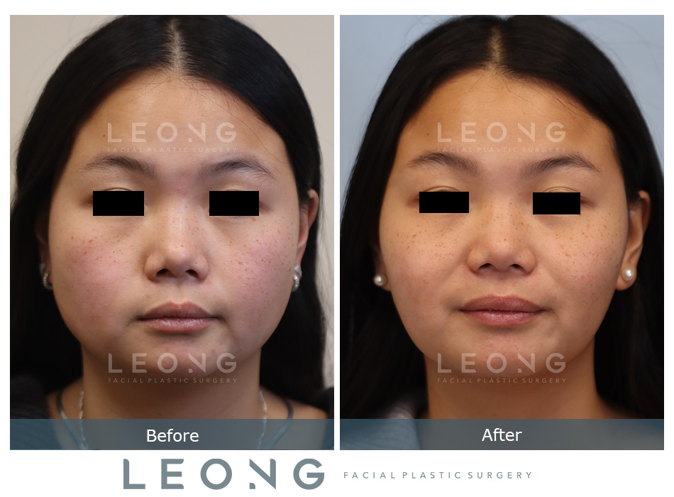 Jawline Slimming Before and After | Leong Facial Plastic Surgery