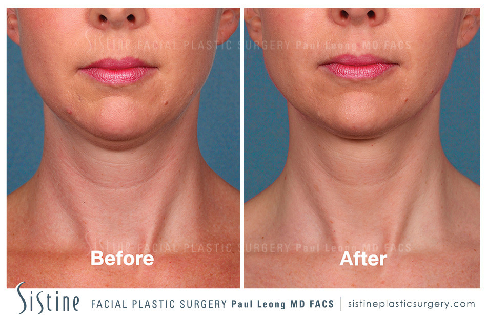 Kybella Before and After | Leong Facial Plastic Surgery