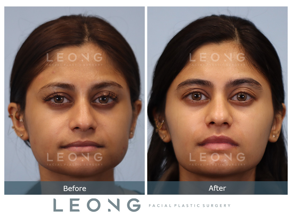 Masseter Before and After | Leong Facial Plastic Surgery
