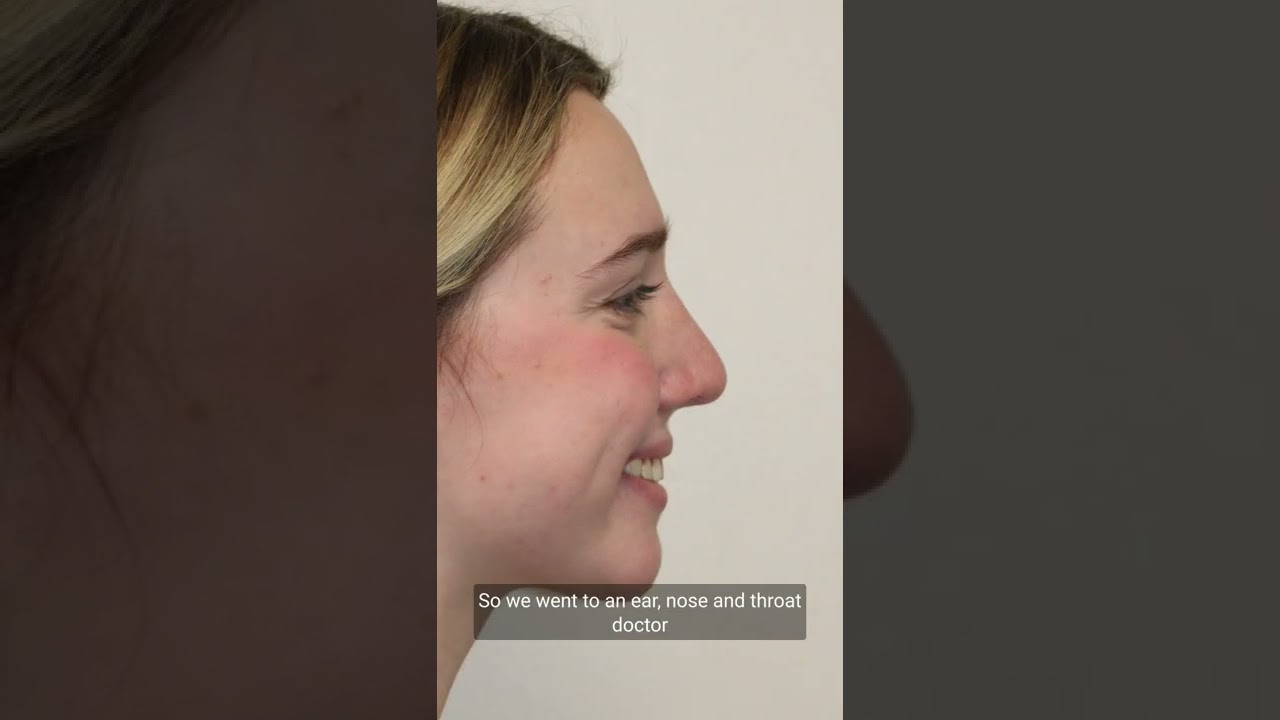 Rhinoplasty video 5